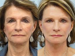 Facial Fat Grafting