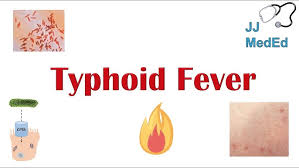 Image result for Typhoid Fever