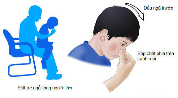Chảy máu cam: Nguyên nhân và cách xử trí - Viện Huyết học - Truyền máu Trung ươngViện Huyết học – Truyền máu Trung ương