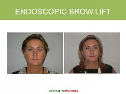 By best by newest by oldest 06:3311 may 2019 rucksana hussain. Endoscopic Brow Lift Before And After Photos Before After Revitalize In Turkey Cosmetic Surgery Aesthetic Dentistry And Hair Transplant In Turkey Cosmetic Surgery Abroad