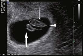 Gestational Sac An Overview Sciencedirect Topics