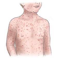 Klassieke Kinderziektes Herkennen Drs Leenarts Dermatoloog