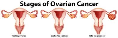 Typically, this is because ovarian cancer symptoms either aren't noticeable in the early stages of the disease or they mimic common stomach and digestive issues that are often women are more likely to experience symptoms once the disease has spread beyond the ovaries, typically to the lymph nodes. The Link Between Ovarian Cancer And Back Pain Pain Resource