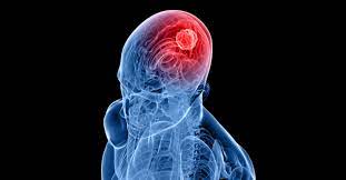 Oct 17, 2021 · โรคมะเร็งสมองในเด็กอายุต่ำกว่า 2 ขวบ ซึ่งเป็นกลุ่มเด็กที่กะโหลกศีรษะยังปิดไม่สนิท เด็กจะมาด้วยอาการกะโหลกศีรษะโต แต่ถ้าเป็นเด็กที่อายุ 2. Pji4stdhemkqpm