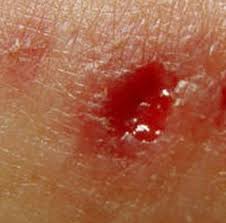 Image result for wolf spider bite skin