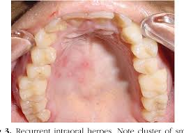 Image result for Oral herpes roof of mouth