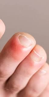 Image result for Chilblains