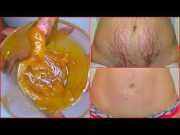 Studies have found that keeping the skin moisturized using oils and emollients can help prevent stretch marks (), ().the remedies discussed below can help keep the skin moisturized, thus preventing and fading stretch marks. Remove Stretch Marks Fast How To Get Rid Of Stretch Marks Effectively Khichi Beauty Youtub Stretch Mark Removal Stretch Marks Beauty Tips For Glowing Skin