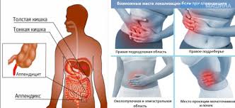 Simptomy Appendicita U Detej Priznaki Chto Delat Pri Bolyah