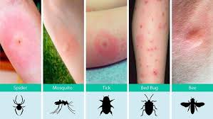 Spider Bites That Look Like Mosquito Bites Pin On Medical