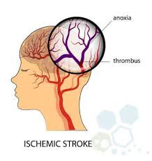 Motus nova© users are making recoveries after stroke. Therapeutic Stem Cells Treatment For Stroke Recovery Rehab