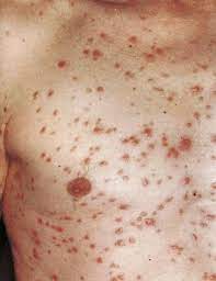 Hantaviruses are a large group of viruses that circulate asymptomatically in rodents, insectivores and bats, but sometimes cause illnesses in humans. Infektionskrankheiten Springerlink