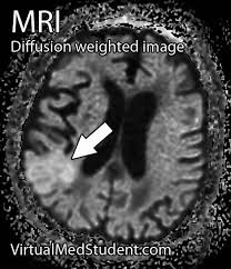 Virtualmedstudent Com Cerebrovascular Accident Stroke Cerebrovascular Accident Medical Pictures Mri