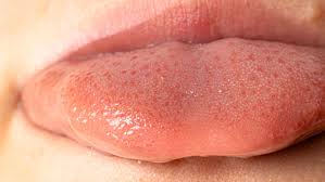 Image result for oral thrush symptoms roof of the mouth