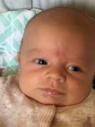 Can teething cause pimple like bump?