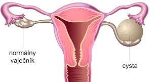 Ovariálne cysty sú vaky tekutiny ktoré rastú vo vnútri alebo na vaječníku. 5 Osvedcenych Veci Pre Prevenciu A Prirodnu Liecbu Cyst Na Vajecnikoch Domaca Liecba