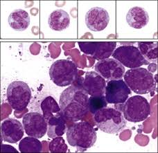 Image result for Acute Leukemia