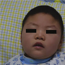 De Novo Variants in CDK19 Are Associated with a Syndrome Involving  Intellectual Disability and Epileptic Encephalopathy