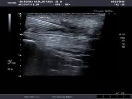 Injectiile cu ozon, efectuate intramuscular, au ca scopul de a stopa contracturile si de a relaxa fibrele muschilor, pentru ca durerea resimtita de pacient sa inceteze. DexametazonÄƒ È™i Dureri Articulare Intrebari Pentru Dr Marius Uscatu Medic Specialist Ortopedie Traumatologie Page 77 Medlife