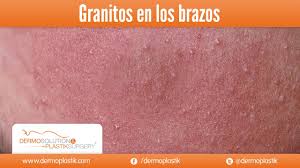 Dermoplastik Granitos En Los Brazos Youtube