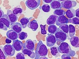 Common symptoms of chronic or acute leukemia may. Que Es La Leucemia Mieloide Cronica Cancer Center Tec100