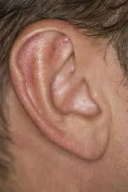 How To Reverse Tinnitus With Vitamins Tinnituscures Tinnitusremedies Tinnitus Remedies Ear Wax Removal Ear Wax Buildup