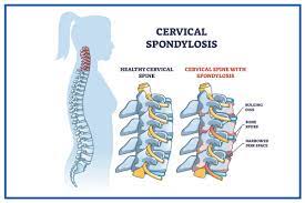 Cervical Spondylosis: Causes, Symptoms, Treatment, Risks - Medicover