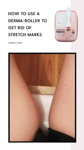 Stretch Mark Bio Oil Before And After Legs How To Get Rid Of Stretch Marks Derma Roller Stretch Marks Stretch Marks Derma Roller