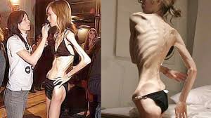 Resultado de imagen para anorexia