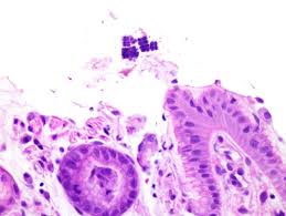 Sarcina ventriculi are gram positive bacteria which are found in water and soil and thrive in low ph as predicted in the literature this is the first case report of sarcina ventriculi in a patient with upper. Arp Press On Twitter Lovely Example Of Sarcina Ventriculi Involving Gastric Mucosa Https T Co Uu8qv9petx Dr Dora Lam Himlin S Series Pmid 21997690 Https T Co Zodzr9aba3