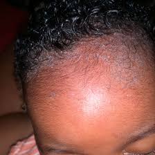 Image result for Cradle Cap