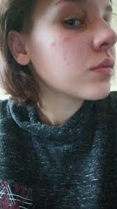 Does anyone know how to stop this... Iv had clear skin most my life and  started using noble soap bar for the breakout but its not going away... Any  tips?