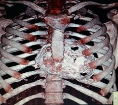 Inflammation is part of the body's natural response to protect itself against harm. Non Contrast Ct Reconstructed Volume Rendered Image Shows Pericardial Download Scientific Diagram