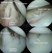 Image result for SLAP Lesion