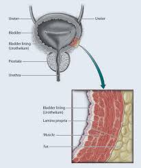 Bladder Cancer Challenge Photocure