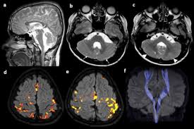 Mirror syndrome is a rare condition during pregnancy that leads to preeclampsia in the mother. Congenital Mirror Movements In A Patient With Alpha Dystroglycanopathy Due To A Novel Pomk Mutation Neuromuscular Disorders