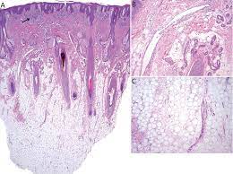 I shed more than both my dogs together! Successful Treatment Of Lipedematous Alopecia Using Mycophenolate Mofetil Html Acta Dermato Venereologica