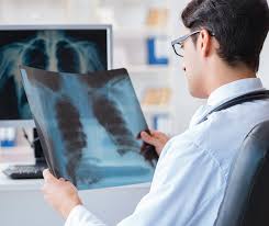 Image result for lung cancer xray