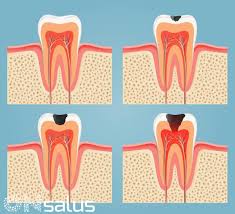 Causas Del Sabor Amargo En La Boca Te Las Explicamos Todas