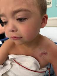 Chance has his port “buddy” removed about 3 weeks ago. It is healing up  nicely. The last picture is the actual port. We could not keep it because  it had to go