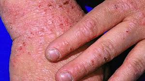 There are different types of depressive disorders. 7 Types Of Eczema Symptoms Causes And Pictures
