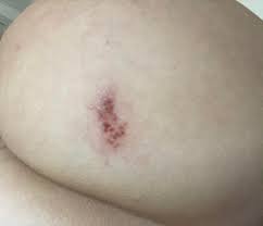Herpes is one of the most common sexually transmitted diseases which can affect multiple organ systems including the lips and genitals. Nsfw Hsv2 Outbreak On Butt Cheek Day Nine Someone Requested A Photo Of The Scabbing Healing Stage So Here It Is This Is With A Course Of 2 X 500mg