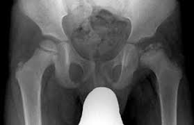 Legg Calve Perthes Disease Wikipedia