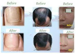 Advancements in hair care science have shown these vitamins to increase the odds of hair growth, with several even delivering the related: Silica Deficiency Or Impaired Silica Metabolism Can Lead To A Variety Of Diseases Silica Ansu Silica Ansu Wellness