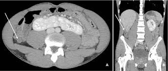 Image result for CT Intravenous Contrast
