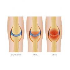 Polyarthrose Ursachen Symptome Behandlung Medlexi De