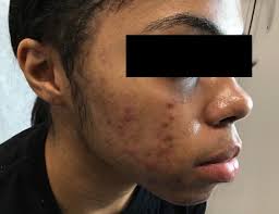 Patient Before and After — Florida Institute of Dermatology