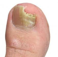 Tener hongos en los pies es una condición común causada por organismos microscópicos que crecen en áreas húmedas y cálidas. Como Tratar Los Hongos De Las Unas Blog De Farmacia