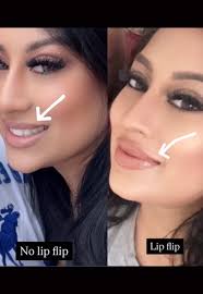 Jalisa Vaughn Lips Before and After