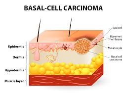 They are commonly found on the head, neck, and arms, yet can form anywhere on the body, including the chest, abdomen, and legs. Basal Cell Carcinoma Symptoms University Health News